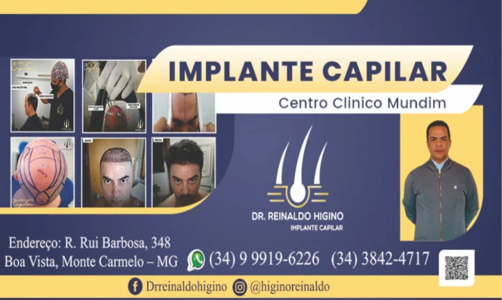 Implante Capilar Dr. Reinaldo Higino